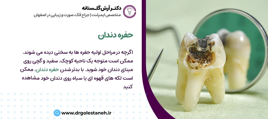 پوسیدگی دندان | مرکز ایمپلنت دیجیتال دکتر آرش گلستانه در اصفهان