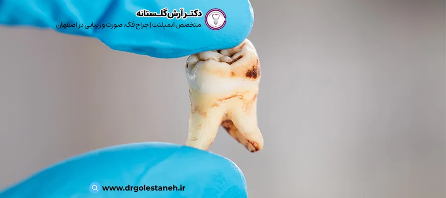 علائم پوسیدگی دندان | دکتر آرش گلستانه
