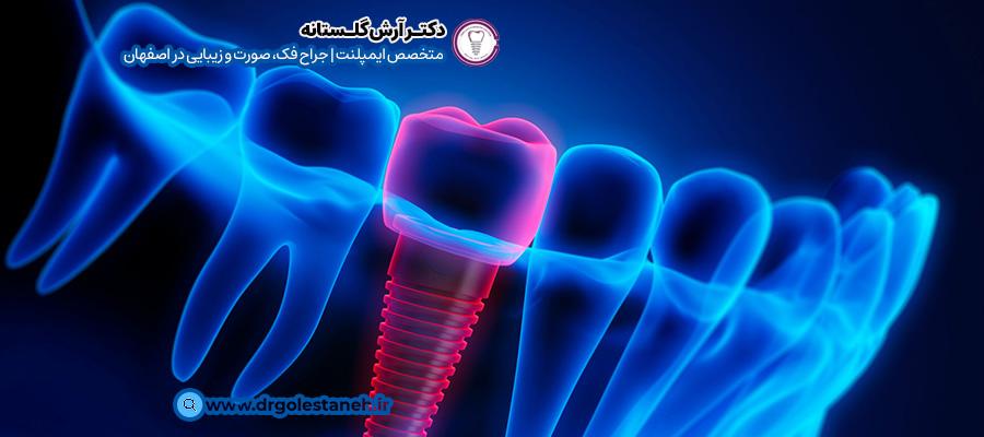 کاندید مناسب برای ایمپلنت اندواستیل | دکتر آرش گلستانه