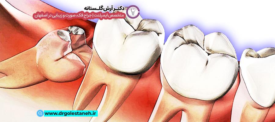 عوارض کشیدن دندان عقل | مطب جراحی دهان، فک و صورت دکتر آرش گلستانه