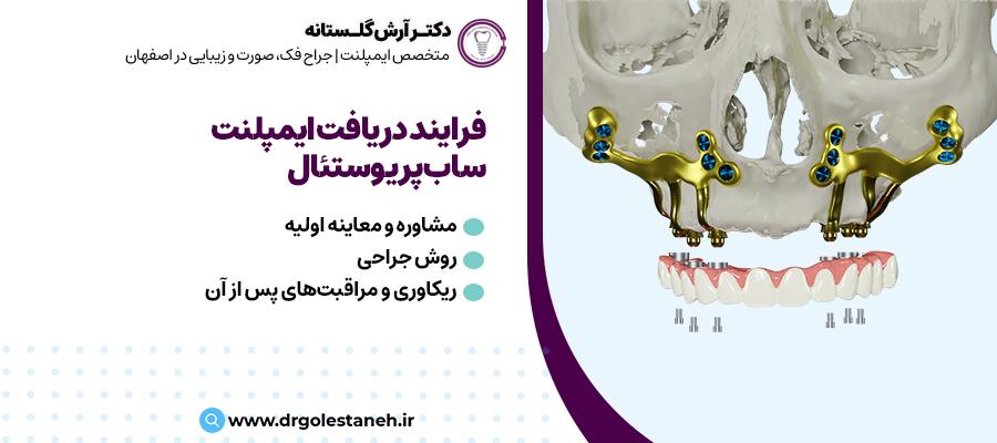 فرایند دریافت ایمپلنت ساب پریوستئال | دکتر آرش گلستانه در اصفهان