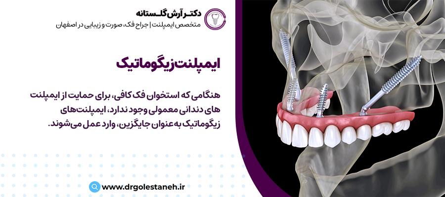 ایمپلنت دندان زیگوماتیک | دکتر آرش گلستانه