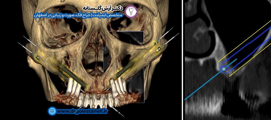 روش کاشت ایمپلنت زیگوماتیک | دکتر آرش گلستانه