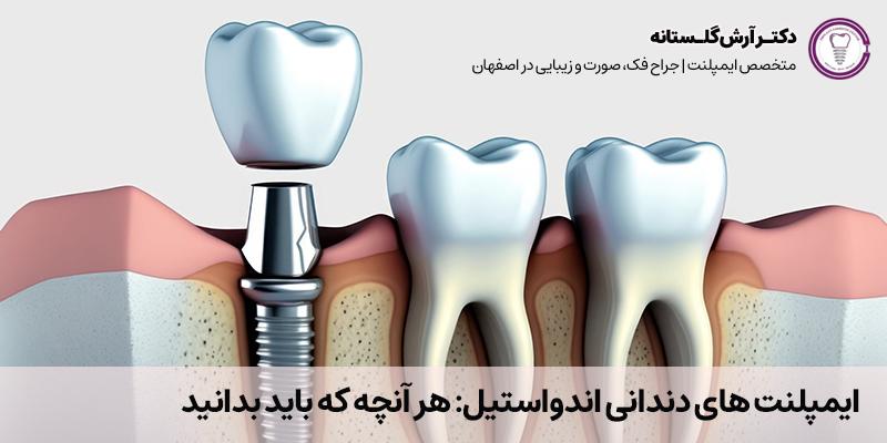 ایمپلنت های دندانی اندوستال: هر آنچه که باید بدانید | دکتر آرش گلستانه