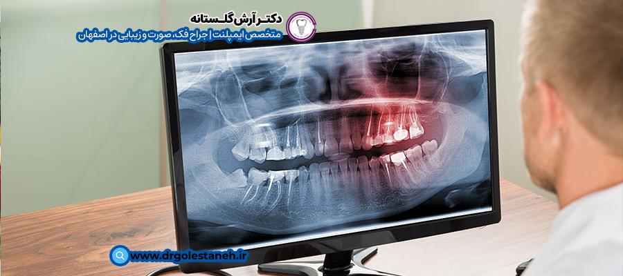 D. CBCT  یا سی‌تی‌اسکن دندان برای ایمپلنت دندان  All-on-4 | مرکز ایمپلنت دندان اصفهان