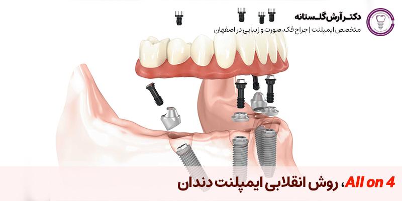 روش انقلابی ایمپلنت دندان All on 4 | دکتر آرش گلستانه