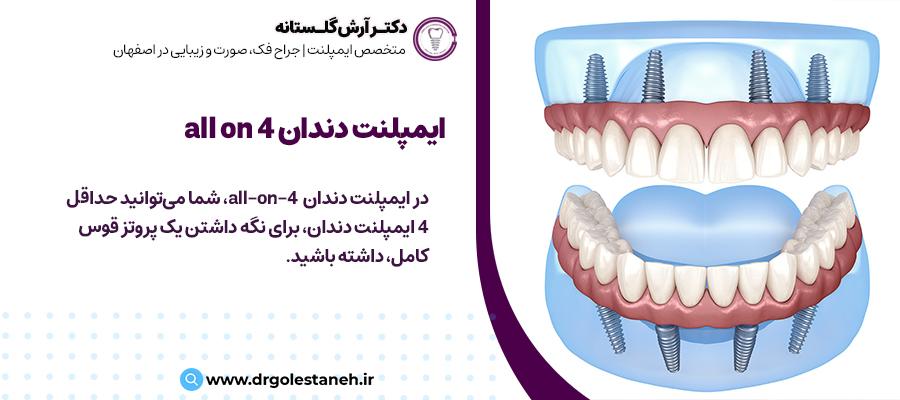 ایمپلنت دندان all-on-4 چیست؟ | دکتر آرش گلستانه