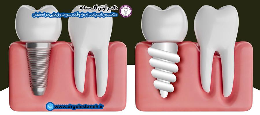 زیبایی‌شناسی و ظاهر ایمپلنت زیرکونیا در مقابل ایمپلنت تیتانیوم | مطب دکتر آرش گلستانه در اصفهان