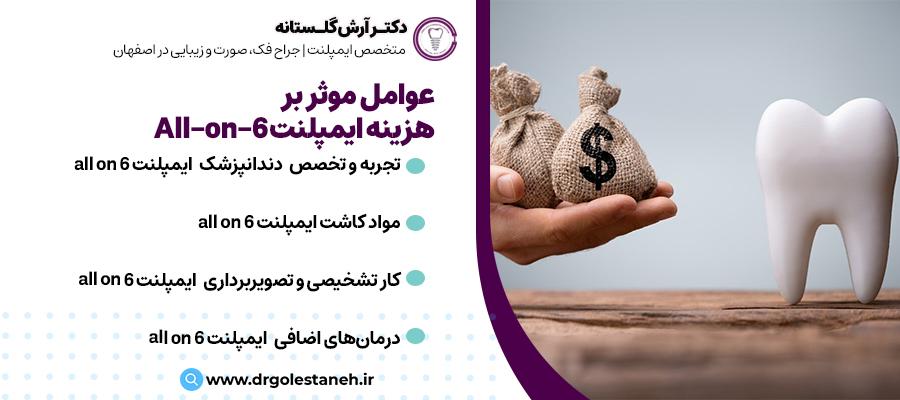 عوامل موثر بر هزینه ایمپلنت All-on-6 | ایمپلنت با قیمت خوب در اصفهان