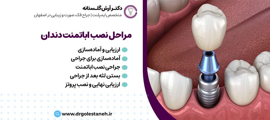 نحوه نصب اباتمنت ایمپلنت چگونه است؟ | دکتر ارش گلستانه، متخصص ایمپلنت 