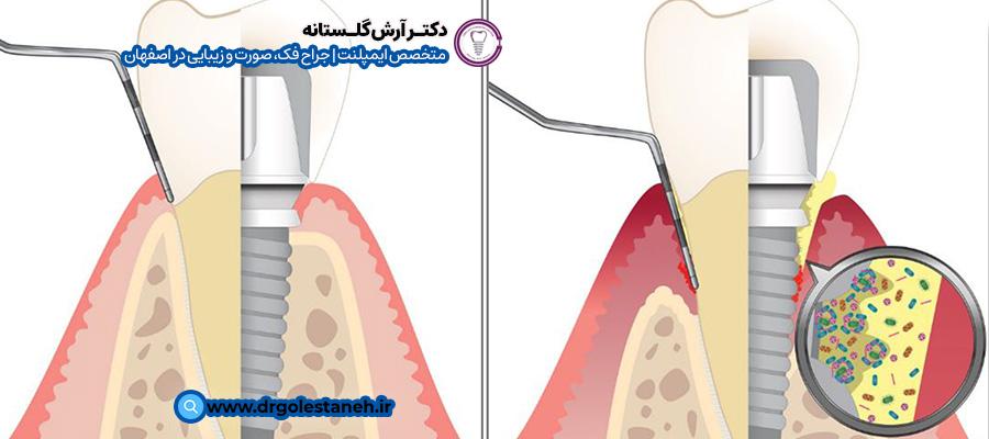 تحلیل‌رفتن لثه پس از جراحی ایمپلنت دندان | دکتر آرش گلستانه در اصفهان