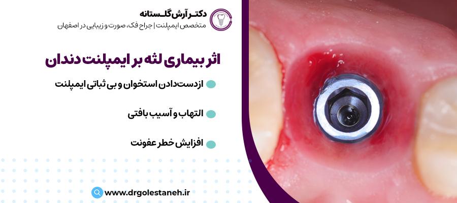 چگونه بیماری لثه بر ایمپلنت دندان تأثیر می‌گذارد | مطب دکتر ارش گلستانه در اصفهان