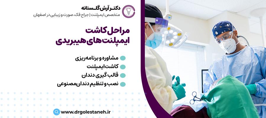 مراحل کاشت ایمپلنت هیبریدی | مطب دکتر آرش گلستانه