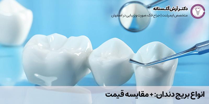 انواع بریج دندان: + مقایسه قیمت | دکتر آرش گلستانه