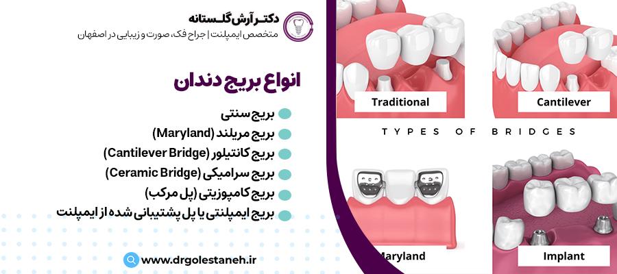 انواع بریج دندان | دکتر آرش گلستانه