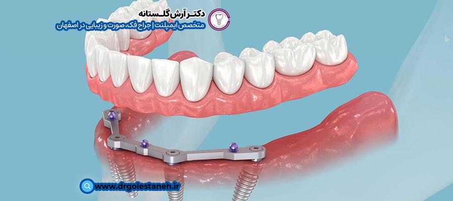 درصد موفقیت ایمپلنت All-on-4 | دکتر آرش گلستانه در اصفهان