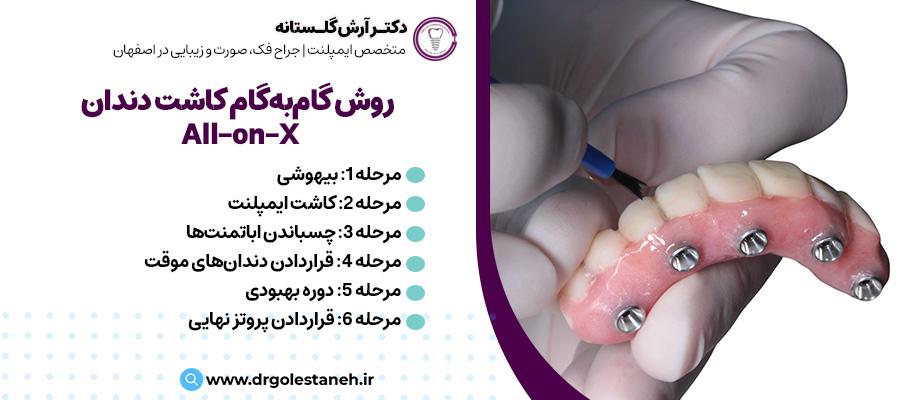 بررسی گام‌به‌گام روش کاشت دندان All-on-X | متخصص ایمپلنت دندان اصفهان