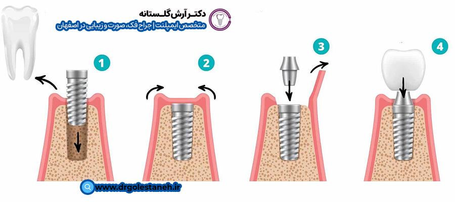 مراحل کاشت دندان تک دندانی چیست؟ | دکتر آرش گلستانه در اصفهان