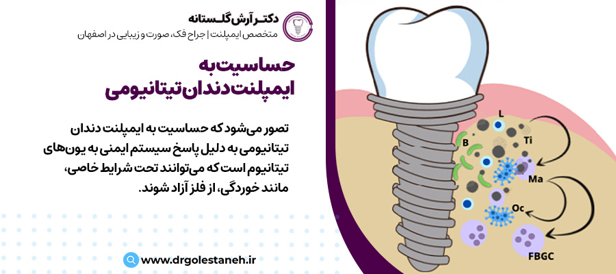 آلرژی به ایمپلنت‌های دندانی: آیا می‌توانم به تیتانیوم حساسیت داشته باشم؟ | دکتر آرش گلستانه