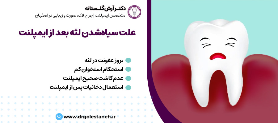 علت سیاه‌شدن لثه بعد از ایمپلنت | دکتر آرش گلستانه در اصفهان