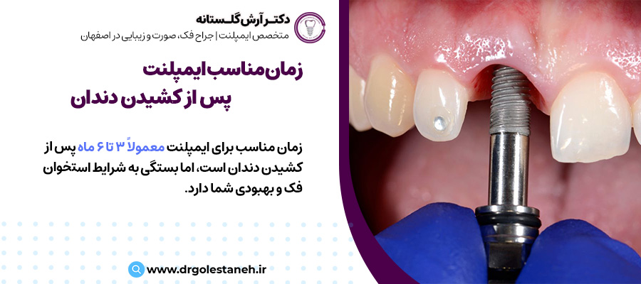 چه مدت پس از کشیدن دندان می‌توانم ایمپلنت انجام دهم؟ | دکتر آرش گلستانه