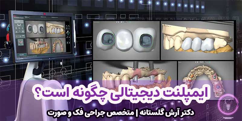 ایمپلنت دیجیتالی چگونه است؟