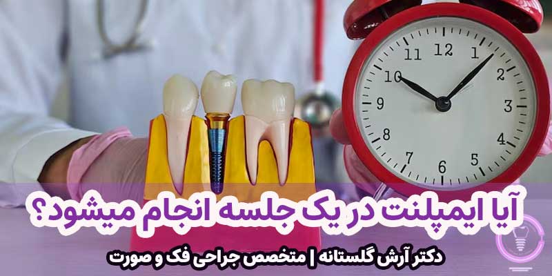 آیا ایمپلنت در یک جلسه انجام میشود؟