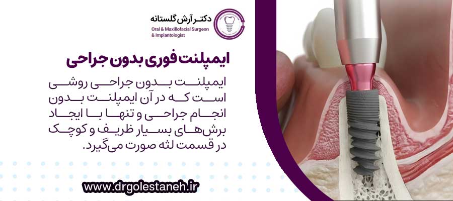 ایمپلنت فوری بدون جراحی