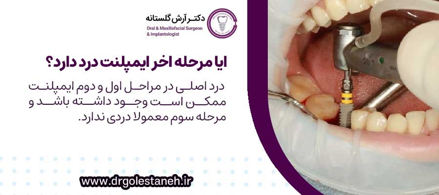 ایا مرحله سوم ایمپلنت درد دارد؟