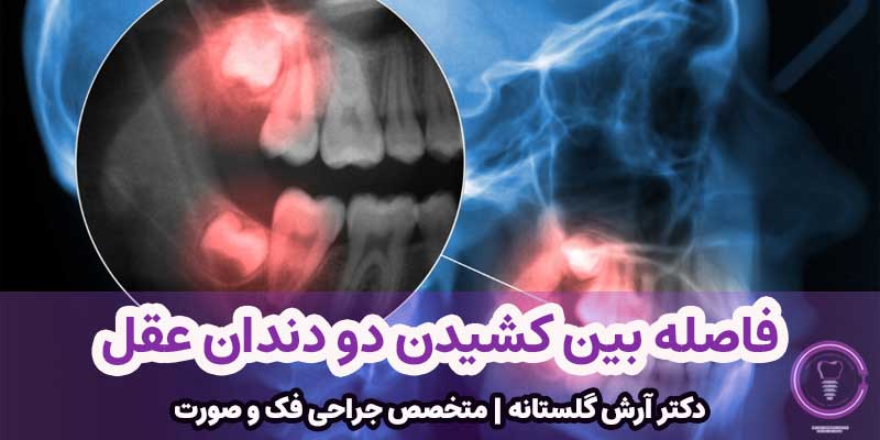 فاصله بین کشیدن دو دندان عقل