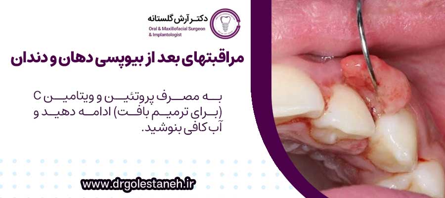 مراقبتهای بعد از بیوپسی دهان و دندان