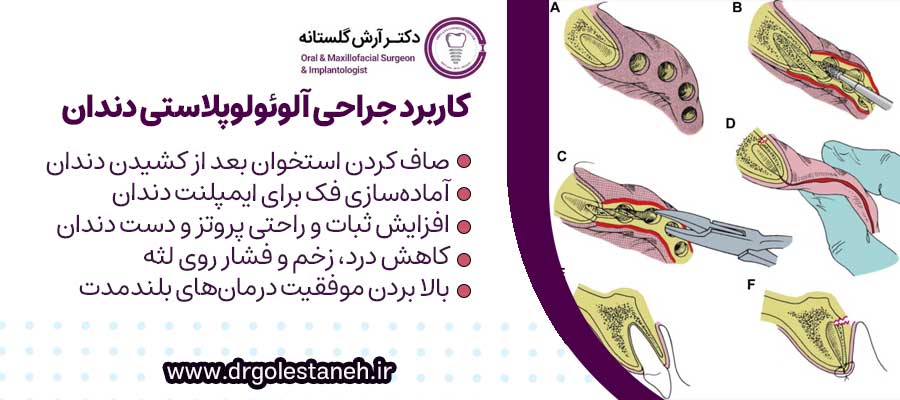 جراحی آلوئولوپلاستی دندان