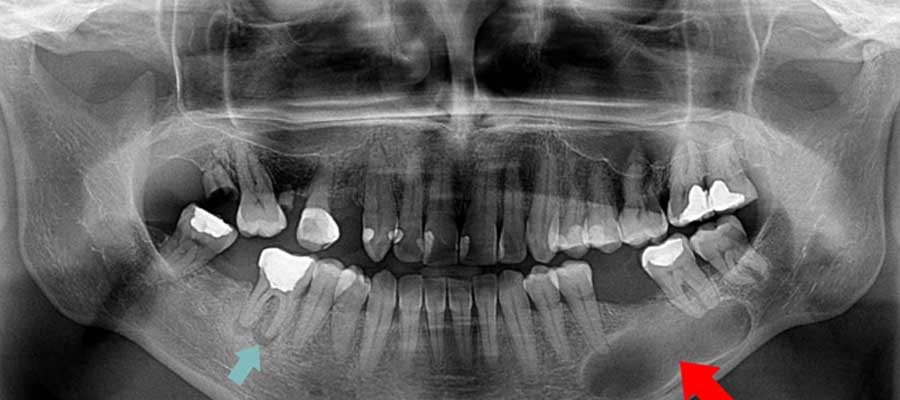 کیست دندان در عکس رادیولوژی