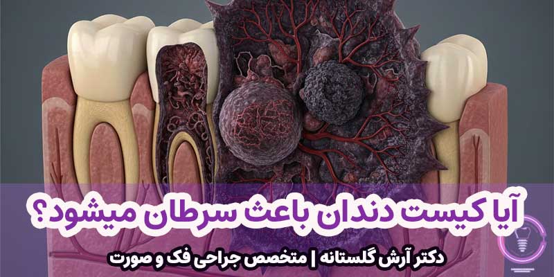 آیا کیست دندان باعث سرطان میشود؟
