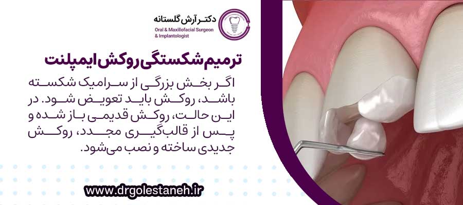 ترمیم شکستگی روکش ایمپلنت