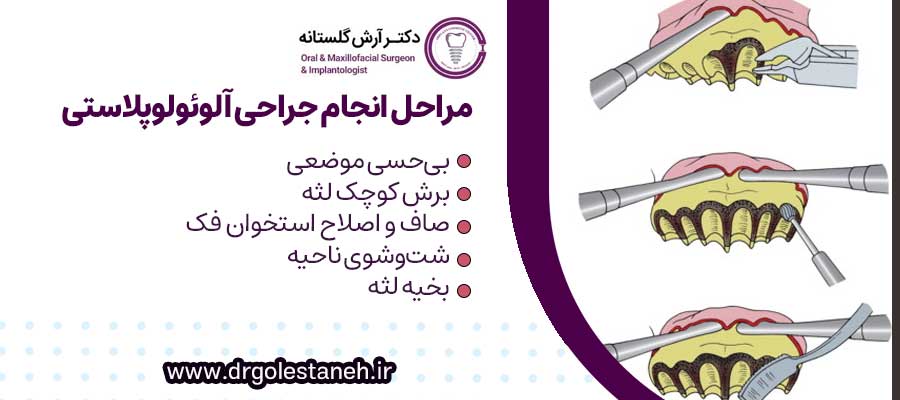 مراحل انجام جراحی آلوئولوپلاستی