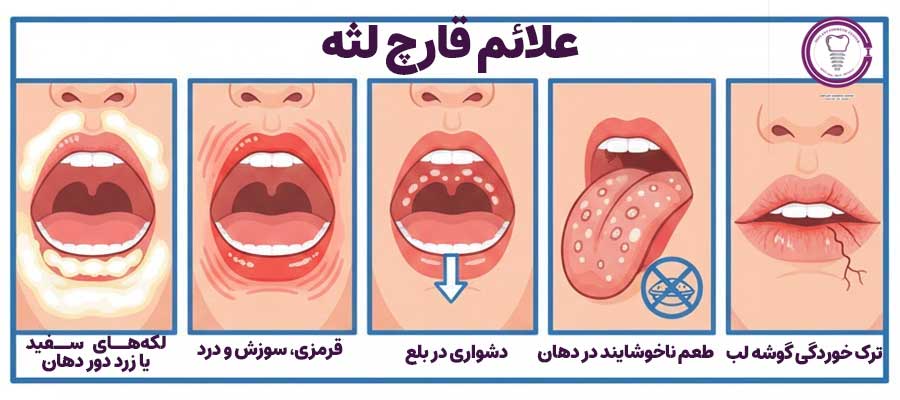 علائم قارچ لثه