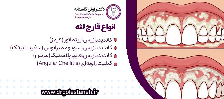 انواع قارچ لثه