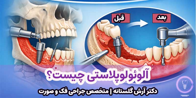 آلوئولوپلاستی چیست؟