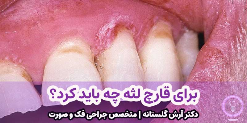 برای قارچ لثه چه باید کرد؟