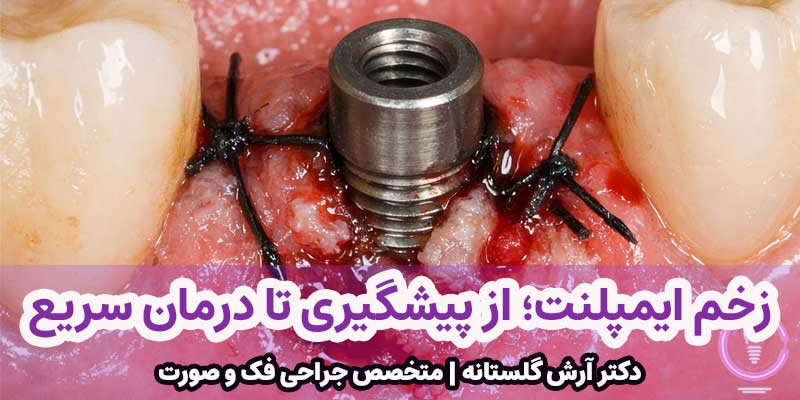 زخم ایمپلنت؛ از پیشگیری تا درمان سریع