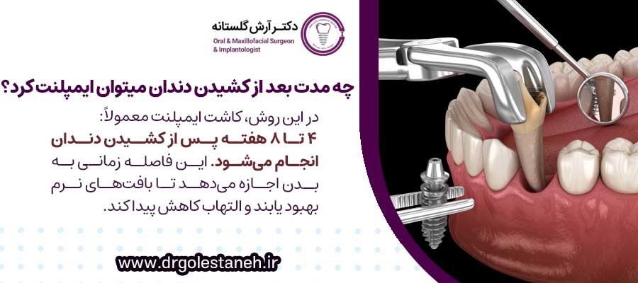چه مدت بعد از کشیدن دندان میتوان ایمپلنت کرد؟