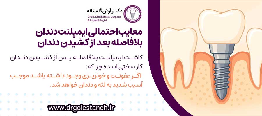 معایب احتمالی کاشت ایمپلنت بلافاصله بعد از کشیدن دندان