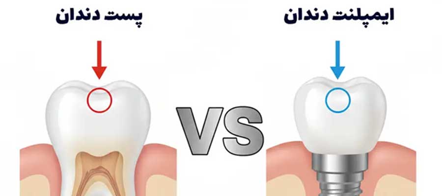 پست دندان یا ایمپلنت؟