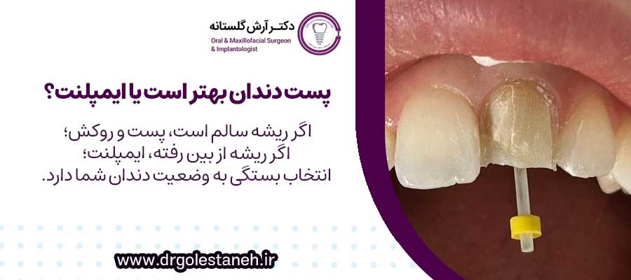 پست دندان بهتر است یا ایمپلنت؟