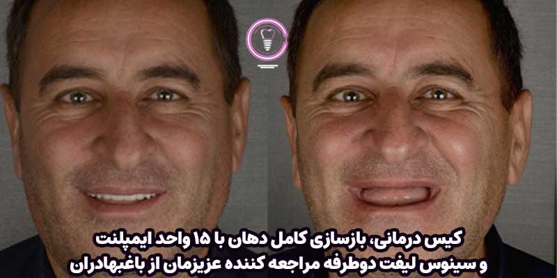 کیس درمانی، بازسازی کامل دهان با ۱۵ واحد ایمپلنت و سینوس لیفت دوطرفه مراجعه کننده عزیزمان از باغبهادران