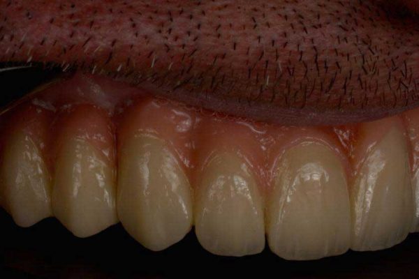 Case therapy treatment result full mouth reconstruction with 15 implants and bilateral sinus lift patient from Baghbahadoran 3 4