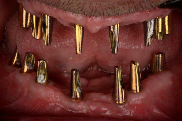 Case therapy treatment steps full mouth reconstruction with 15 implants and bilateral sinus lift referring from Baghbahadoran 2