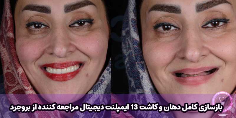 بازسازی کامل دهان و کاشت 13 ایمپلنت دیجیتال مراجعه کننده از بروجرد