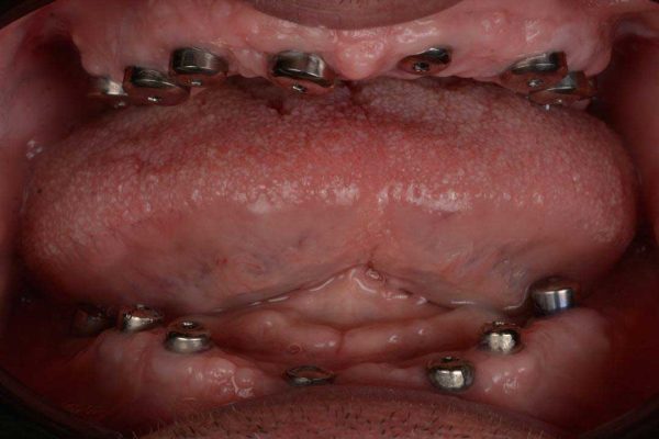 Diagnosis stage of case treatment full mouth reconstruction with 15 implants and bilateral sinus lift referring from Baghbahadoran 1 1 3
